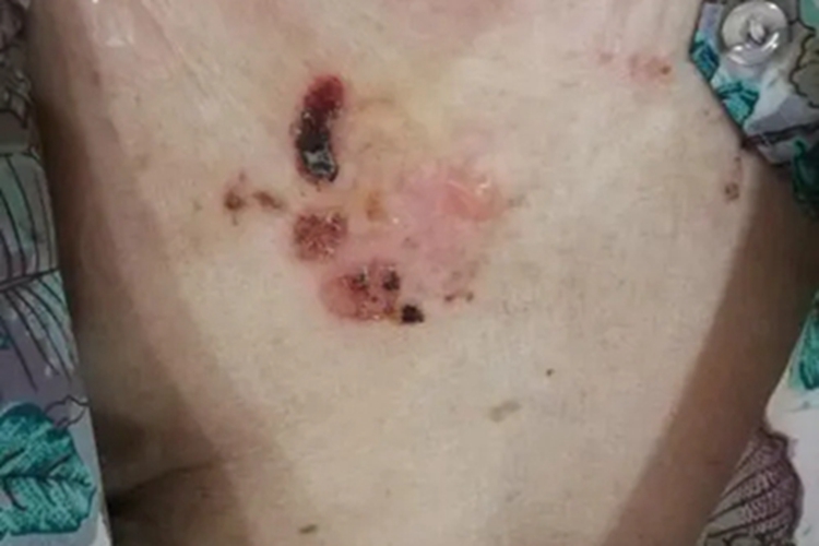 副肿瘤性天疱疮胸部红斑图