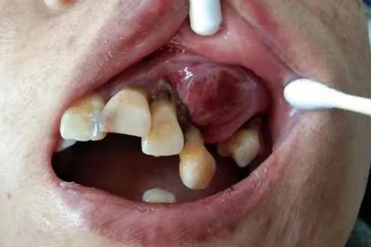 上颌骨囊肿口腔内图