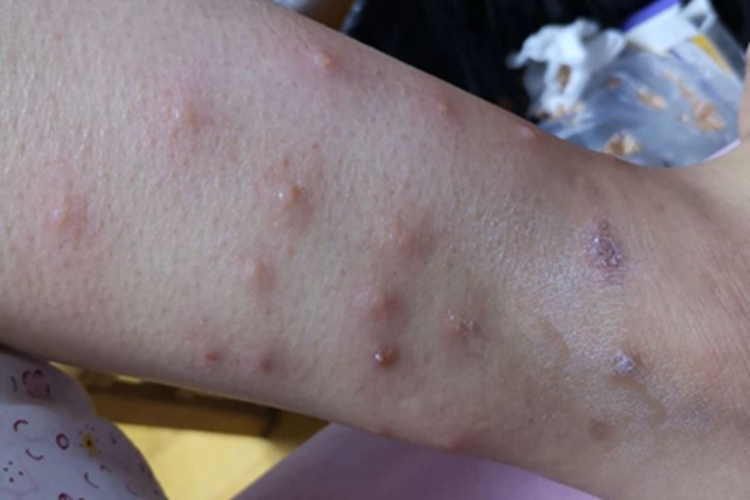 跳蚤叮咬小腿水疱图 跳蚤叮咬小腿水疱图