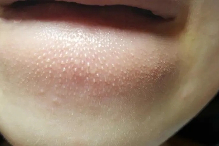 嘴周粟丘疹图