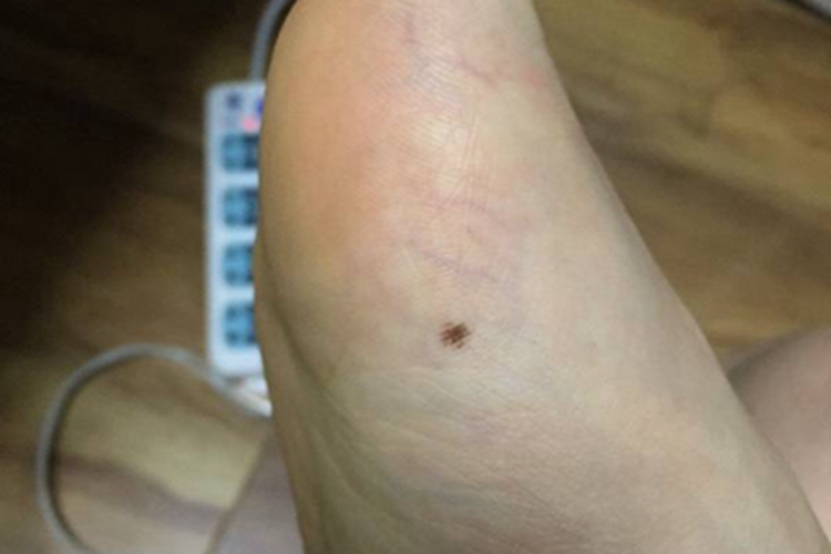 交界痣脚部症状图