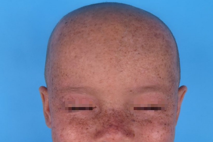 着色性干皮病头部症状图