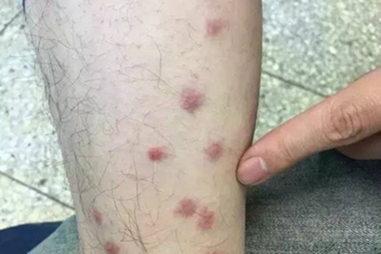 刺毛虫皮炎小腿症状图