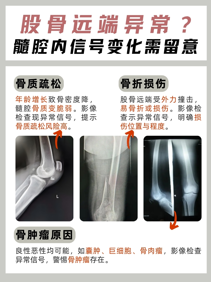 股骨远端异常？髓腔内信号变化需留意