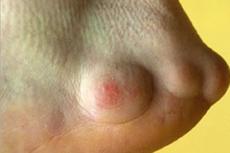 持久性隆起性红斑脚后跟疙瘩图 持久性隆起性红斑脚后跟疙瘩图