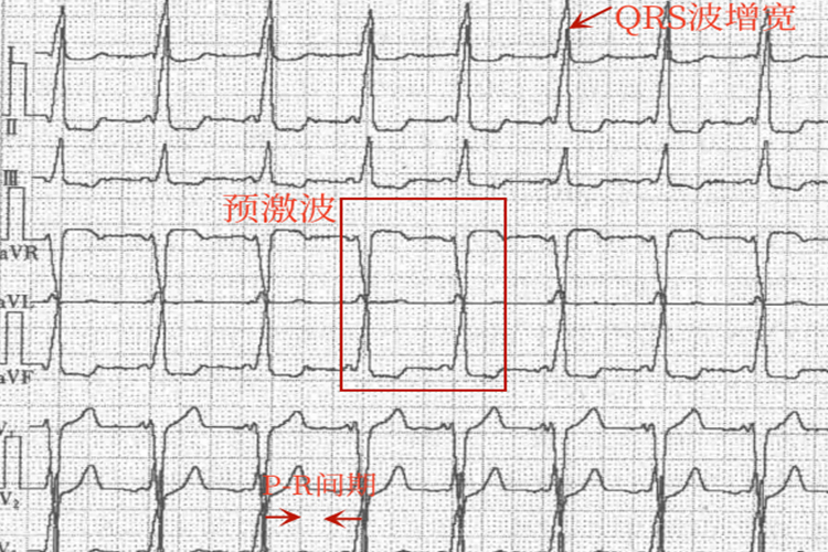WPW综合征心电图 WPW综合征心电图
