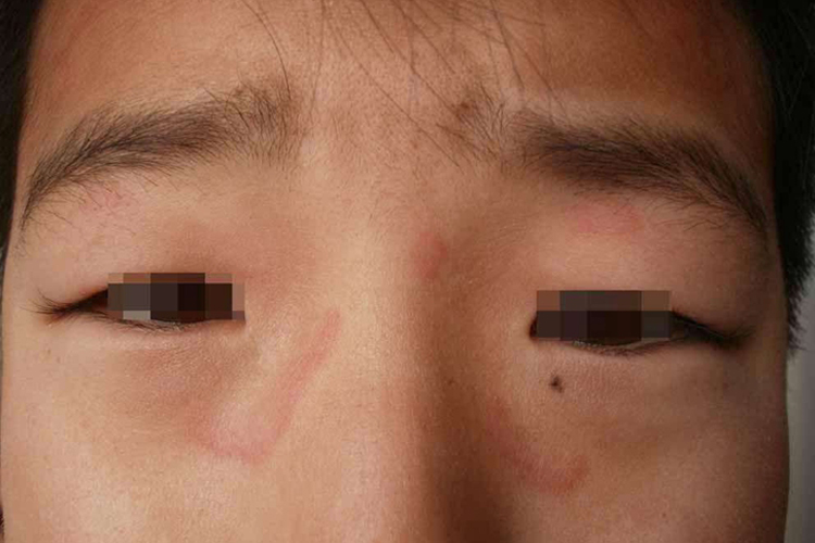 离心性环状红斑图