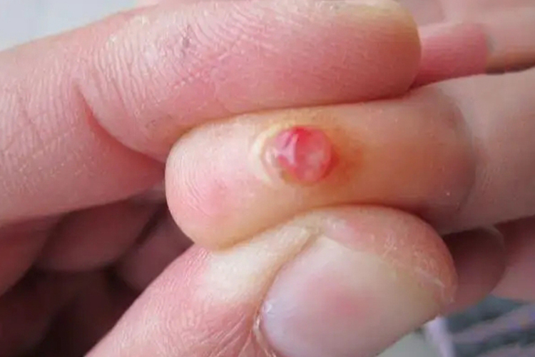 肉芽组织名词解释