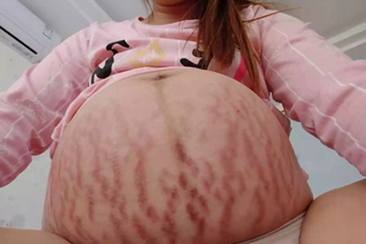 萎缩纹肚子上都是暗红色纹图