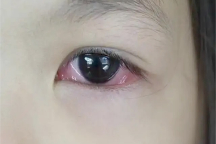 儿童结膜炎眼球血丝图