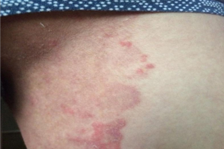 股癣大腿根不规则红斑图