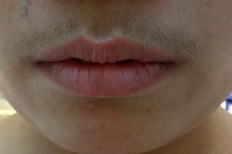 多囊卵巢综合征口周症状图