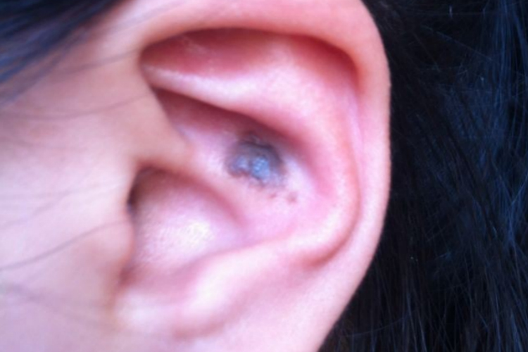 耳朵黑色斑块图