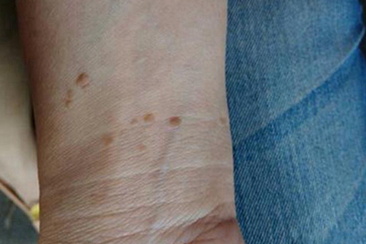 扁平疣手腕症状图