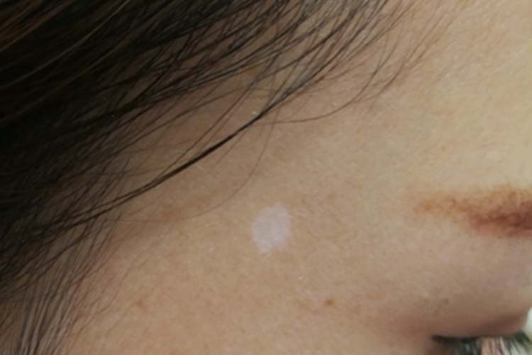 老年性白斑面部白斑图