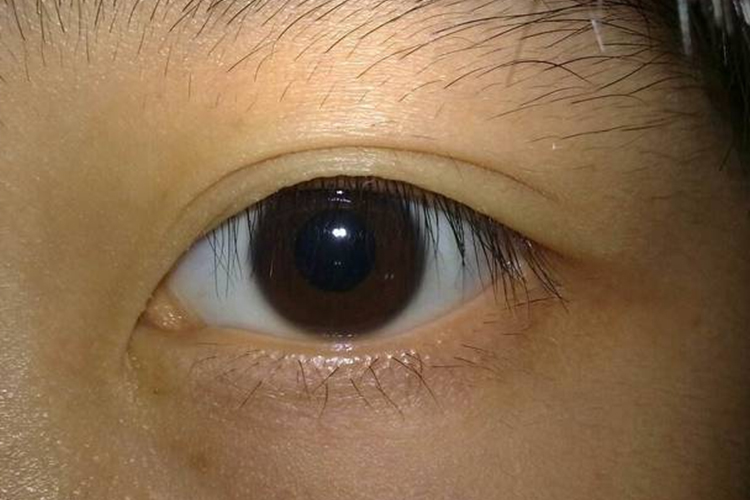正常眼睛图