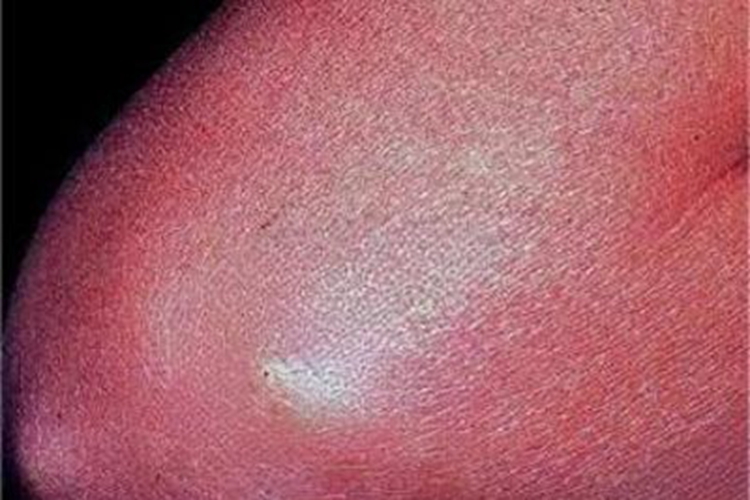 风湿热胳膊肘长结节图 风湿热胳膊肘长结节图