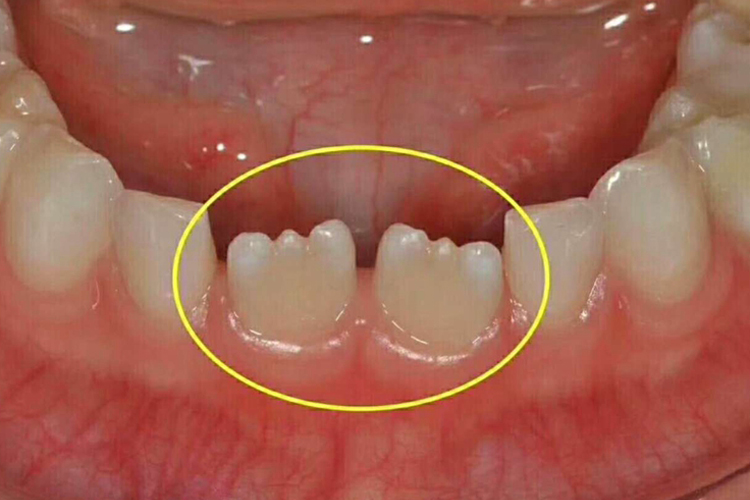 正常的切缘结节图 正常的切缘结节图