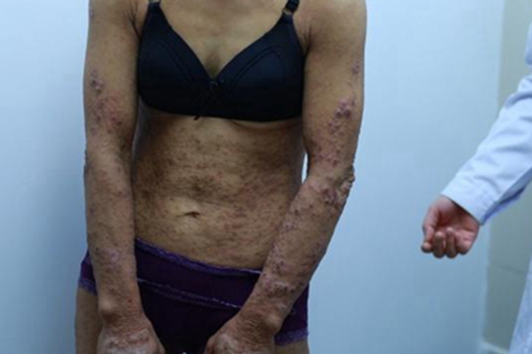 瘙痒症全身丘疹图