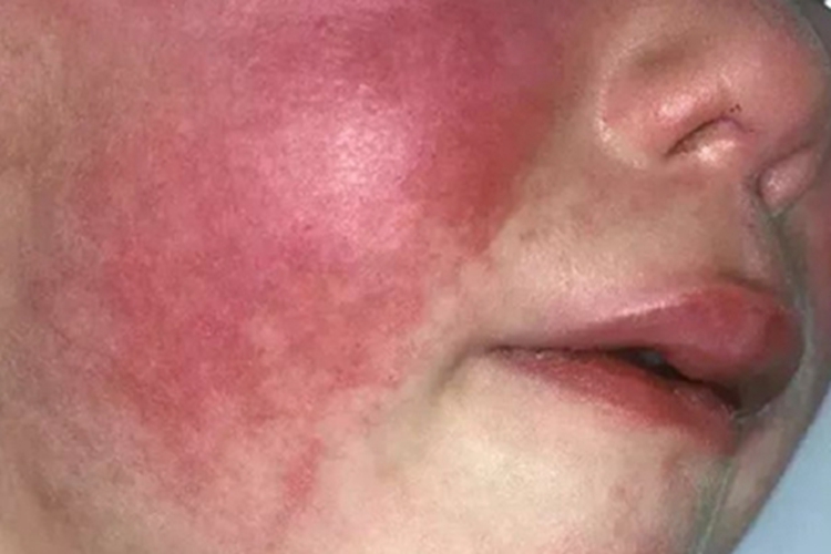 普通型猩红热面部丘疹图