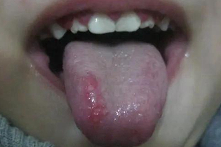小儿口疮舌头红斑图