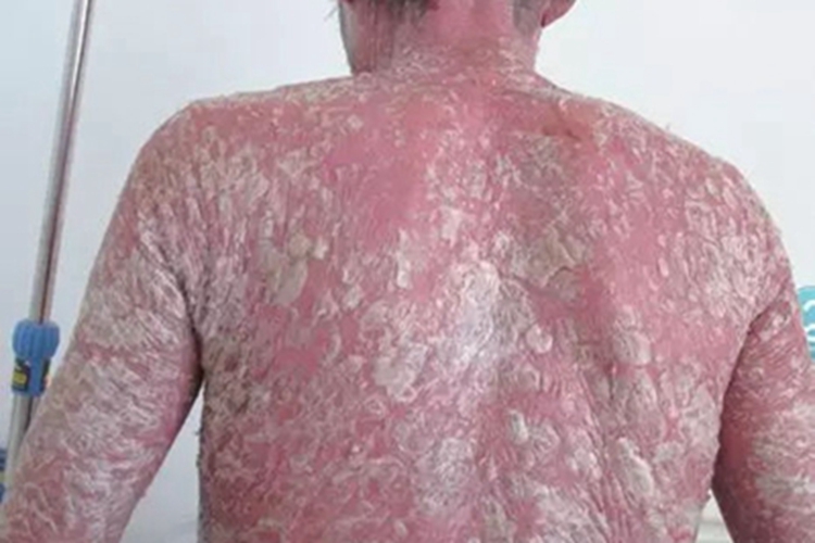 松皮癣背部皮肤增厚图