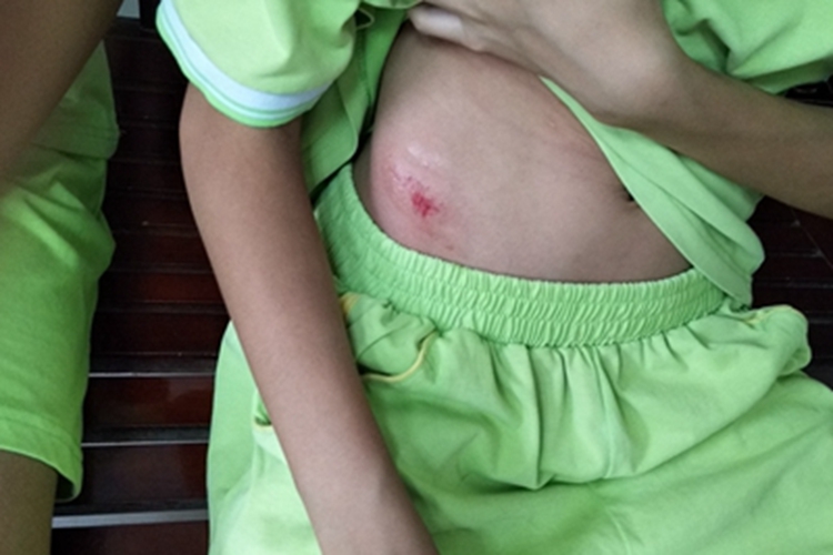 跌伤右下腹有擦痕脱皮图