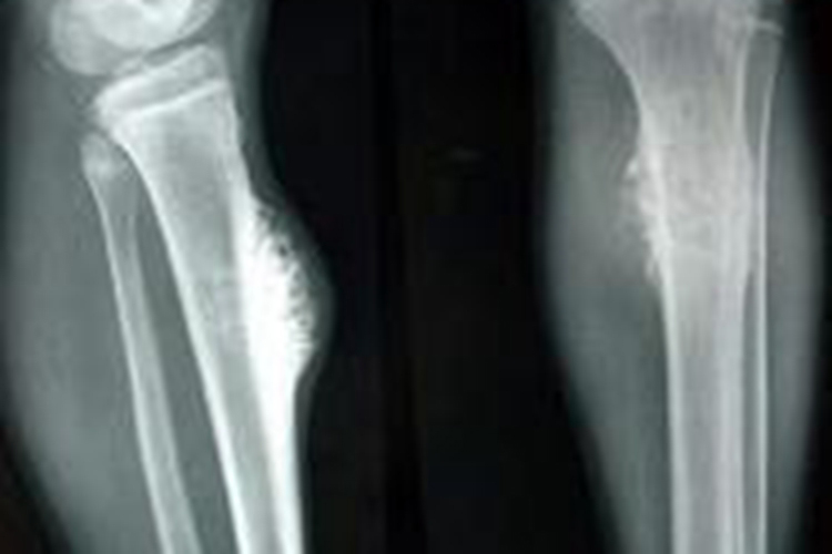 小腿胫骨骨癌早期肿块X线图 小腿胫骨骨癌早期肿块X线图