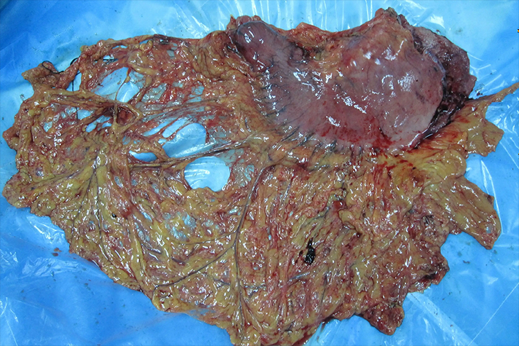 胃癌早期肉眼观黏膜发白图