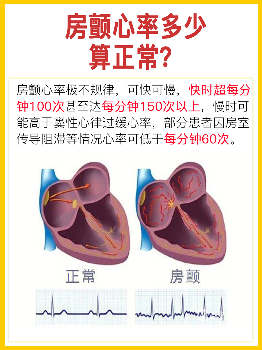 房颤的心率多少算正常呢?一文有答案!