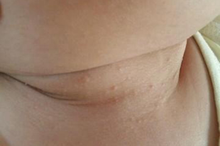 儿童丘疹性肢端皮炎前颈小丘疹图