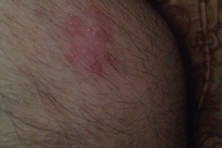 头皮脓疱糜烂性皮病头皮发红图