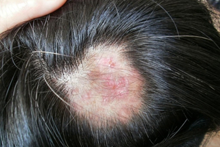 进行性特发性皮肤萎缩头皮红斑图