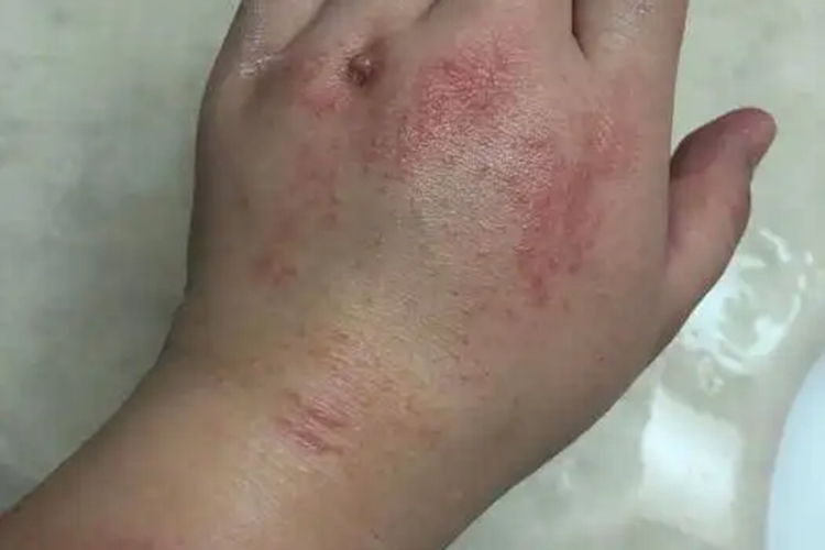 切削液过敏皮肤红斑图