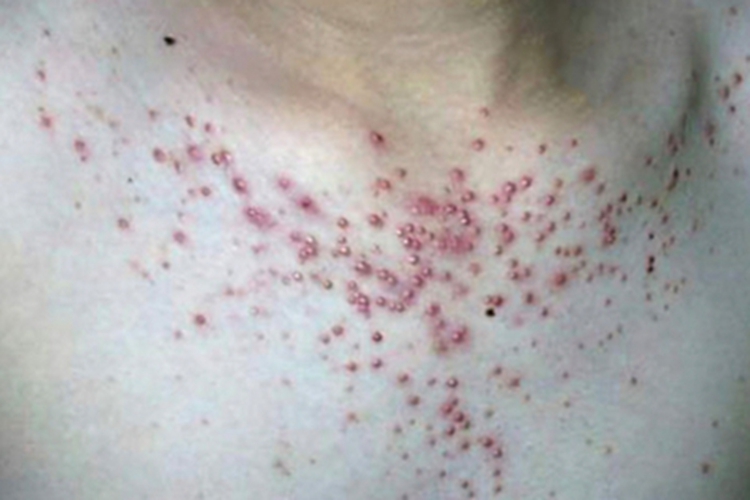 艾滋病胸部红色疙瘩图 艾滋病胸部红色疙瘩图