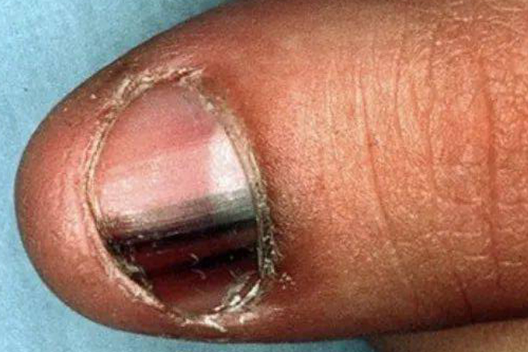 早期甲母痣恶变的卫星状损害图