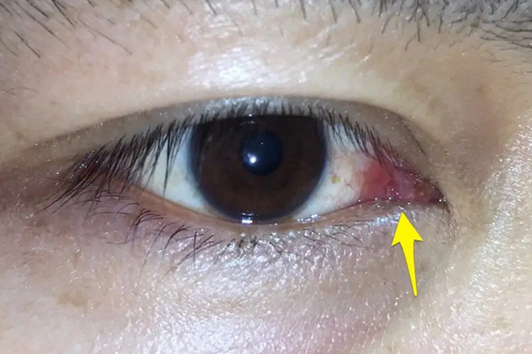 淋球菌性结膜炎图