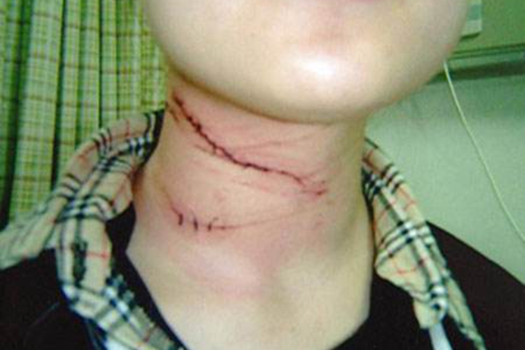 颈部外伤脖子疼图