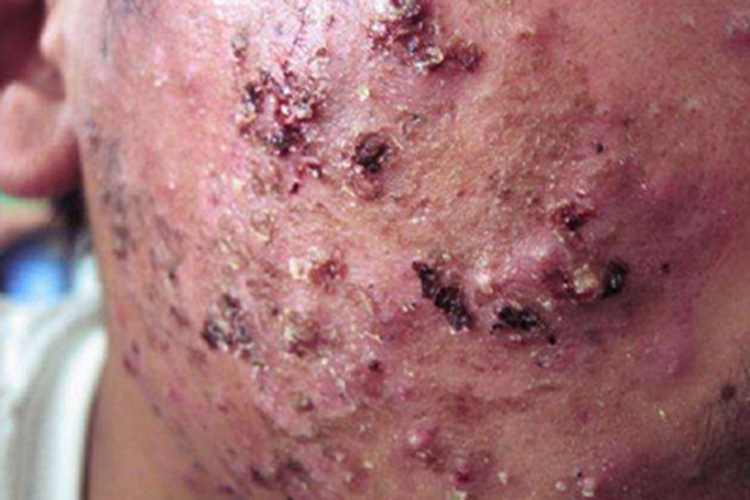 暴发性痤疮面部长丘疹结痂图 暴发性痤疮面部长丘疹结痂图
