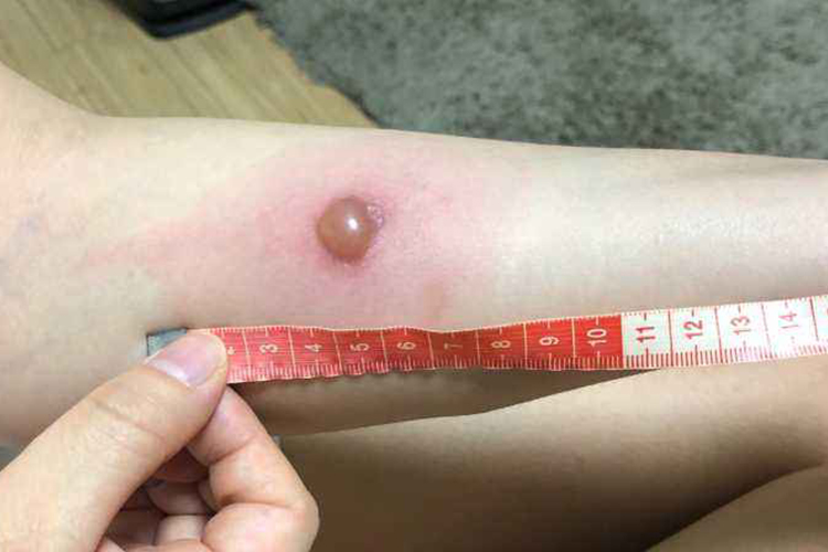 PPD皮肤试验阳性皮肤水疱图