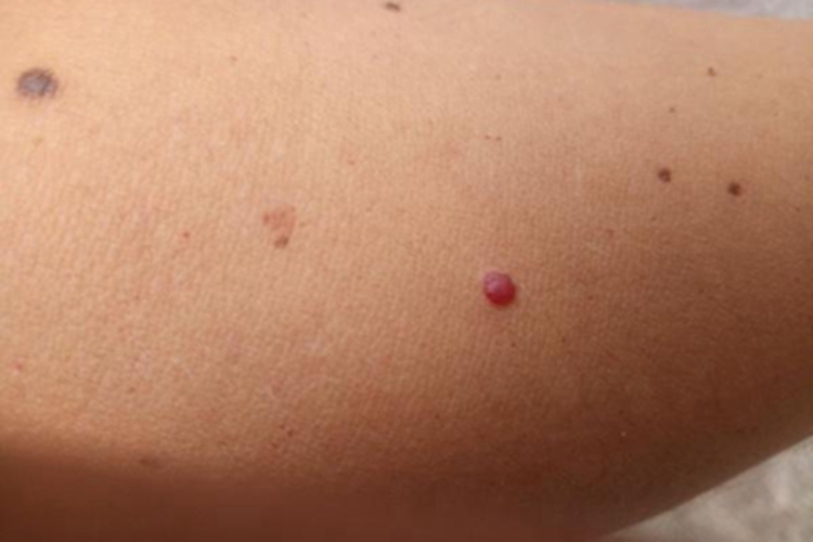樱桃状血管瘤小腿圆疙瘩图