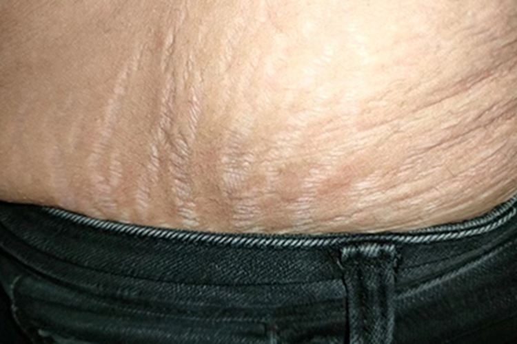 萎缩纹腰部条纹图