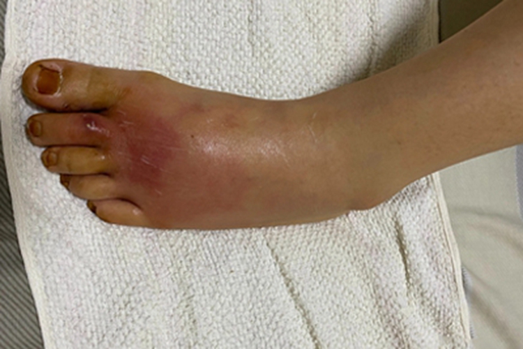 急性淋巴管炎脚背水疱图 急性淋巴管炎脚背水疱图