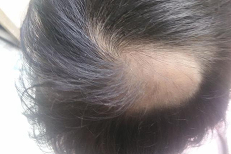 维生素E缺乏症头皮脱发图