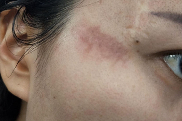 擦伤面部皮肤颜色加深图