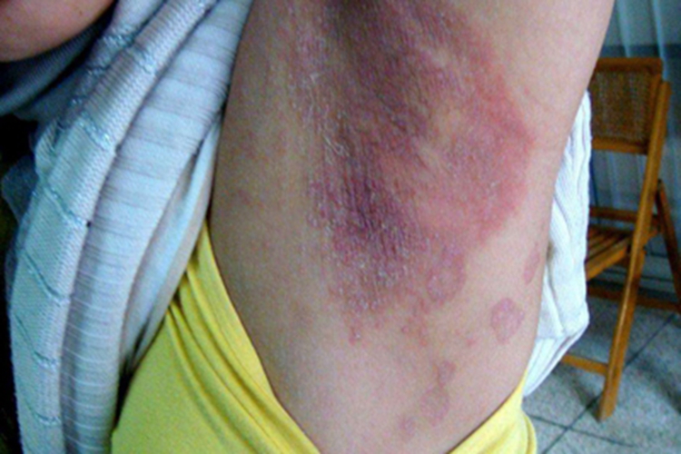 青年成人期特应性皮炎腋下暗红图