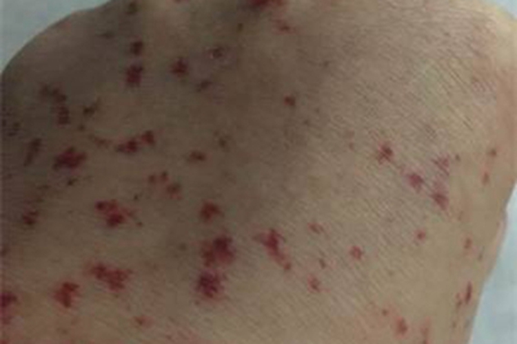 过敏性紫癜手背症状图 过敏性紫癜手背症状图