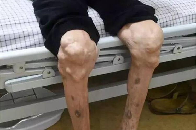 痛风晚期关节畸形图