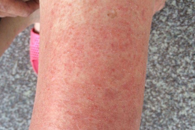接触性皮炎大腿丘疹图