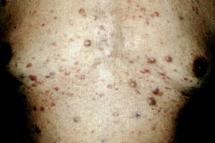 白血病红色斑疹和多形红斑图
